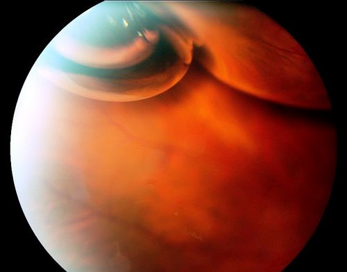 C3F8 Gas Bubble for retinal tear/ Pneumatic Retinopexy
Võtmesõnad: Retinal Detachment