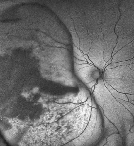 Large Choroidal Melanoma with Retinal Detachment
Patient notices a decline in her vision for the past 3-weeks in her right eye. VA was light perception in the right eye. Fundus photo shows a very large melanoma temporal to the optic nerve and retinal detachment inferiorly. Patient will under go proton beam therapy. 
