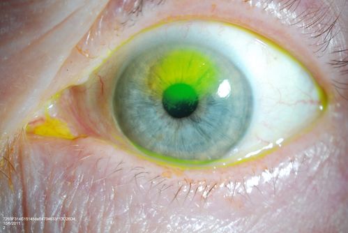 Cornea Ulcer/Abrasion
Keywords: june2012