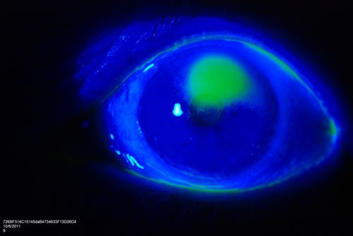 Cornea Ulcer/Abrasion
