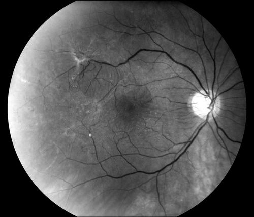 Schlüsselwörter: macular pucker