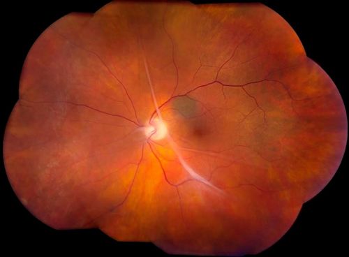 Schlüsselwörter: macular pucker