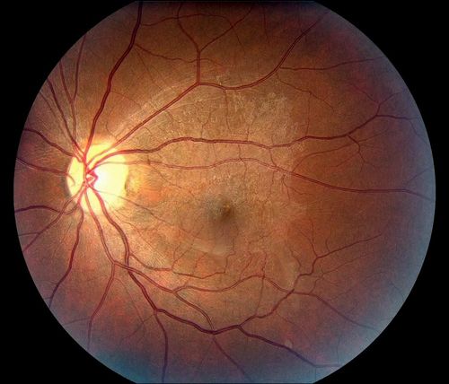 Keywords: macular pucker
