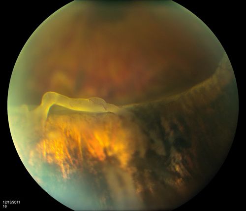Retinal Tear, the retina tear is flipped over
Keywords: Retinal Detachment