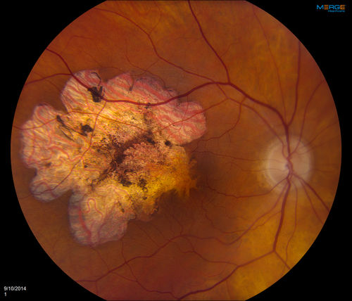 Hypertrophy of the Retinal Pigment Epithelium
Patient comes in with vision changes in the right eye. VA is 20/30 in the right eye. Fundus and FAF photos show a large area of Hypertrophy in the right eye.
Keywords: september2014
