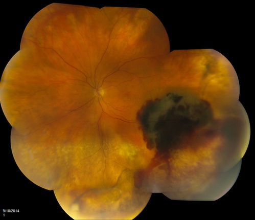 Retinal Hemorrhage
Fundus photo shows retinal hemorrhage located inferior, temporal to the macula in the left eye. 
