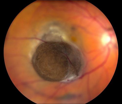Choroidal Melanoma
Keywords: june2012
