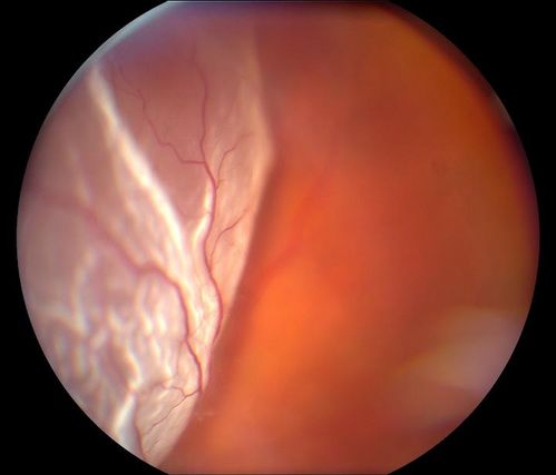 Retinal Detachment
Keywords: Retinal Detachment
