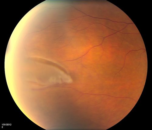 Retinal Tear
Keywords: Retinal Detachment