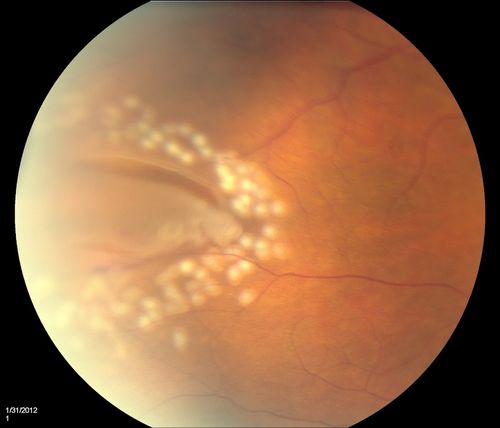 Retinal Tear with Laser
Schlüsselwörter: Retinal Detachment