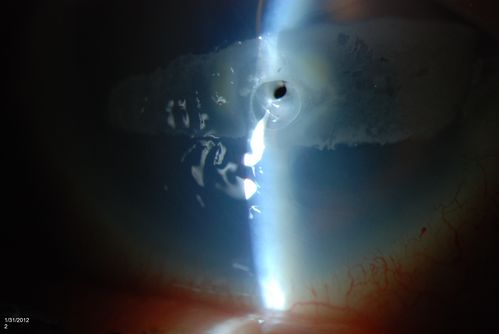 Corneal Ulcer. 
A hole in the cornea. Aqueous Humor leak
