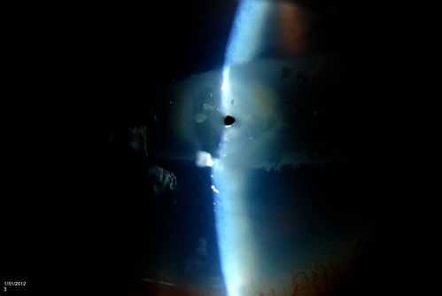 Corneal Ulcer. 
A hole in the cornea. Aqueous Humor leak
