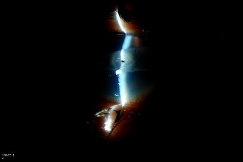 Corneal Ulcer. 
A hole in the cornea. Aqueous Humor leak
