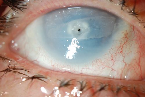 Corneal Ulcer. 
A hole in the cornea. Aqueous Humor leak
