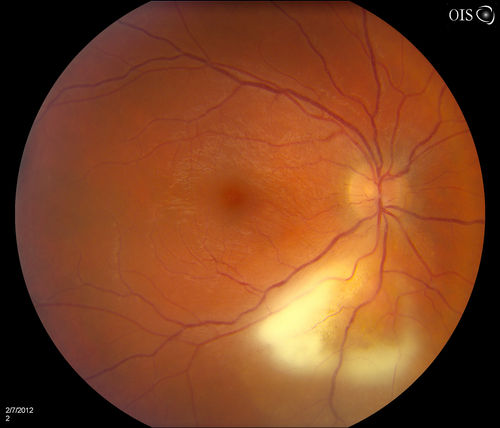 Chorioretinal Toxoplasmosis
A 28-year old male who noticed an upper partial visual loss to his right eye for about 2-weeks. Diagnosed with retinitis and was put on acyclovir. Patient received second opinion due to culture of aqueous humor which was then diagnosed as Toxoplasmosis. VA was 20/25 in the right eye. Pt has been followed after for the past 7-months. 
