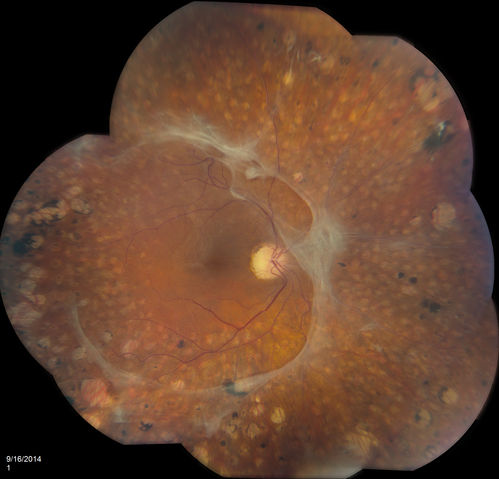 Vitreo-Traction due to Diabetic Retinopathy
Patient comes in for follow up on her diabetes. VA is 20/30 in the right eye. Fundus photos shows thick traction nasally to the optic nerve forming a ring around the macula. Will follow up in 6-months.
Keywords: september2014