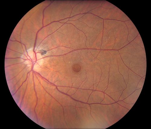 Keywords: macular hole