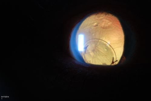 Free Floating Dislocated Lens in Vitreous
Patient comes in aphakic with dislocated lens floating to the back of the eye when laying down. Lens is  laying up against the endothelium of the cornea when patient is right side up..
