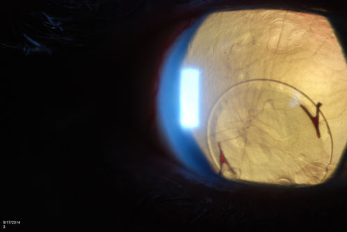 Free Floating Dislocated Lens in Vitreous
Patient comes in aphakic with dislocated lens floating to the back of the eye when laying down. Lens is  laying up against the endothelium of the cornea when patient is right side up..
Keywords: september2014