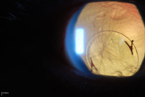 Free Floating Dislocated Lens in Vitreous
Patient comes in aphakic with dislocated lens floating to the back of the eye when laying down. Lens is  laying up against the endothelium of the cornea when patient is right side up..
