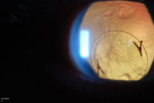 Free Floating Dislocated Lens in Vitreous
Patient comes in aphakic with dislocated lens floating to the back of the eye when laying down. Lens is  laying up against the endothelium of the cornea when patient is right side up..
