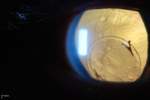 Free Floating Dislocated Lens in Vitreous
Patient comes in aphakic with dislocated lens floating to the back of the eye when laying down. Lens is  laying up against the endothelium of the cornea when patient is right side up..
