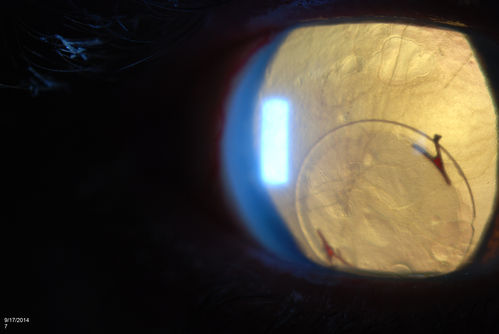 Free Floating Dislocated Lens in Vitreous
Patient comes in aphakic with dislocated lens floating to the back of the eye when laying down. Lens is  laying up against the endothelium of the cornea when patient is right side up..

