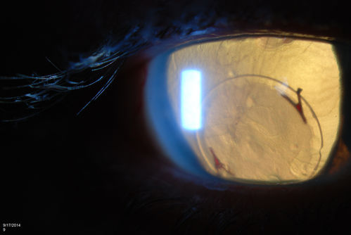 Free Floating Dislocated Lens in Vitreous
Patient comes in aphakic with dislocated lens floating to the back of the eye when laying down. Lens is  laying up against the endothelium of the cornea when patient is right side up..
