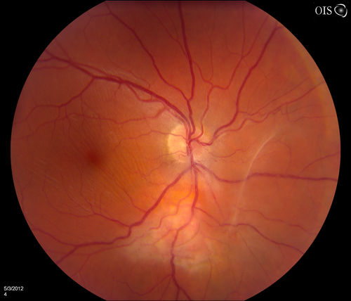 Toxoplasmosis - Vitreoretinal Traction
A 28-year old male who noticed an upper partial visual loss to his right eye for about 2-weeks. Diagnosed with retinitis and was put on acyclovir. Patient received second opinion due to culture of aqueous humor which was then diagnosed as Toxoplasmosis. VA was 20/25 in the right eye. Pt has been followed after for the past 7-months. 
