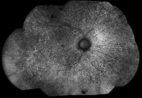 Choroidal Dystrophy
Keywords: dystrophy