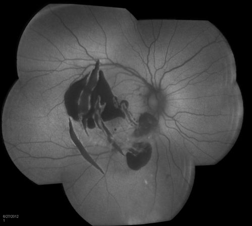 Montage FAF of Coroidal Rupture
Schlüsselwörter: choroidal rupture