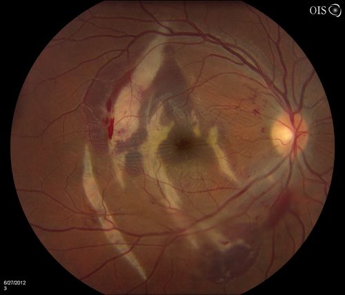 Adult male with trauma to the right eye and orbital floor fracture. Hemorrhage with Choroidal Rupture. 
Keywords: choroidal rupture;july2012