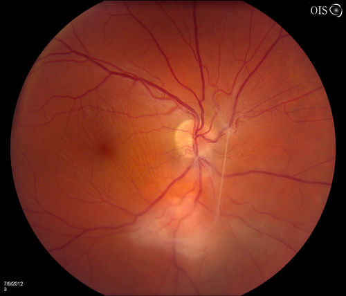 Toxoplasmosis - Vitreoretinal Traction
A 28-year old male who noticed an upper partial visual loss to his right eye for about 2-weeks. Diagnosed with retinitis and was put on acyclovir. Patient received second opinion due to culture of aqueous humor which was then diagnosed as Toxoplasmosis. VA was 20/25 in the right eye. Pt has been followed after for the past 7-months. 
