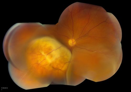Choroidal Melanoma with Retinal Detachment
57 year old female who underwent proton beam therapy for Choroidal Melanoma. VA was 20/400 at post op visit.
Mots-clés: july2012