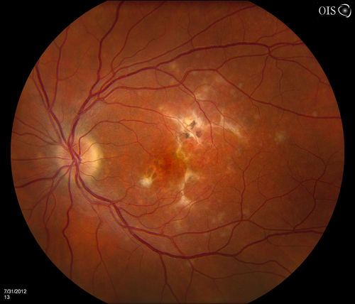 Multifocal Choroidits Vitiligo ( Voght- Kayanagi-Harada Syndrome )
36-year old patient with decreased vision in both eyes with fatigue for over a year. VA 20/25-OD, 20/60 -OS. Patient was treated with Avastin and oral prednisone. 
