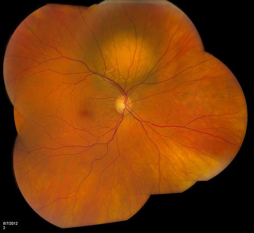Metastasis Choroidal Melanoma 
71-year old female who has undergone chemotherapy treatment for breast cancer. Choroidal Melanoma was from metastasis from her breast cancer. VA is 20/20 as the tumor is in the superior aspect above the optic nerve. 
