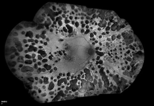 FAF Montage of Diabetic Retinopathy
70-year old male with severe Diabetic Retinopathy. VA at visit was 20/100 with no improvement with pinhole. Patient had recently undergone cataract surgery to try to regain some of his vison. Panoretinal Photocoagulation scars 360 degrees around the retina...
Keywords: Diabetic