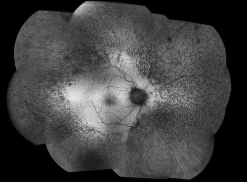 Probable Measles Retinopathy
52-year old female wanted second opinion on retinal eval. Patient had PK and PDT in the left eye. VA was 20/30, right eye was count fingers. Pinhole was NI, both eyes. Patient's mother had measles. Notice pigment changes in both the color and FAF photo. 
