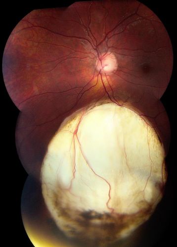 Retinal Coloboma
14-year old male presents with decreased vision in the left eye. Dx with iris and retinal coloboma in the left eye. Patient VA was 20/20, right eye, 20/100 left eye with pinhole improvement 20\50. Patient was fitted for SCL in the left eye.
Keywords: august2012