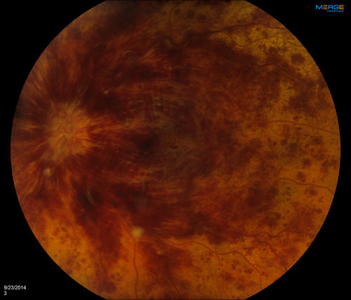 Retinal Vein Occlusion
Patient comes in with loss of vision, left eye. VA is count fingers in the left eye. Fundus photos show large vein occlusion with macular edema in the left eye. Patient proceeded with Avastin Injection..
