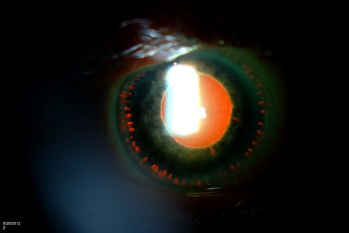 Trans-Illumination Defects
74-year old patient who VA 20/70 OD, 20/50 OS. Complaints of blurred vision. Iris atrophy, both eyes. ERM, right eye, Patient to have cataract surgery to improve distance vision. 
