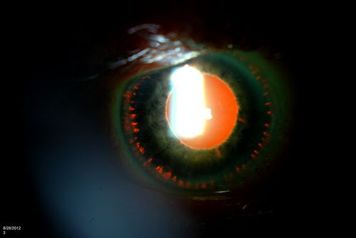 Trans-Illumination Defects
74-year old patient who VA 20/70 OD, 20/50 OS. Complaints of blurred vision. Iris atrophy, both eyes. ERM, right eye, Patient to have cataract surgery to improve distance vision. 

