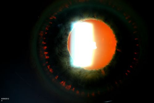 Trans-Illumination Defects
74-year old patient who VA 20/70 OD, 20/50 OS. Complaints of blurred vision. Iris atrophy, both eyes. ERM, right eye, Patient to have cataract surgery to improve distance vision. 
