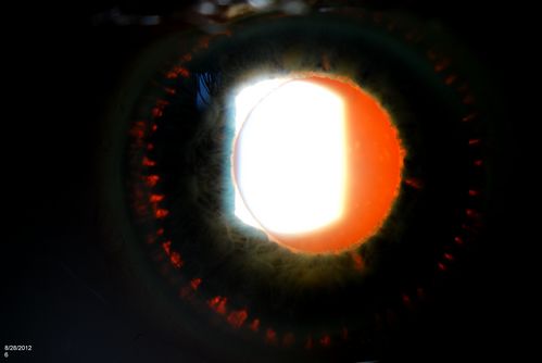 Trans-Illumination Defects
74-year old patient who VA 20/70 OD, 20/50 OS. Complaints of blurred vision. Iris atrophy, both eyes. ERM, right eye, Patient to have cataract surgery to improve distance vision. 
