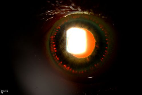 Trans-Illumination Defects
74-year old patient who VA 20/70 OD, 20/50 OS. Complaints of blurred vision. Iris atrophy, both eyes. ERM, right eye, Patient to have cataract surgery to improve distance vision. 
