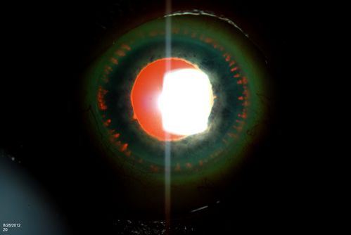 Trans-Illumination Defects
74-year old patient who VA 20/70 OD, 20/50 OS. Complaints of blurred vision. Iris atrophy, both eyes. ERM, right eye, Patient to have cataract surgery to improve distance vision. 
