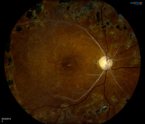 Retinal Artery Occlusion
Patient comes in for eval on artery occlusions in both eyes. VA is 20/400, right eye and NLP, left eye. Fundus photos show paniretinal scars in the right eye with arterial narrowing and the left eye has arterial narrowing as well.

