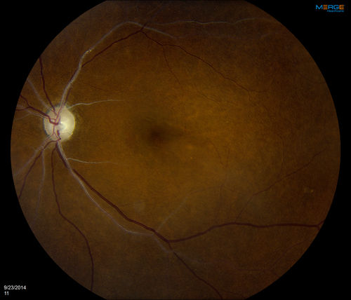 Retinal Artery Occlusion
Patient comes in for eval on artery occlusions in both eyes. VA is 20/400, right eye and NLP, left eye. Fundus photos show paniretinal scars in the right eye with arterial narrowing and the left eye has arterial narrowing as well.
Keywords: september2014