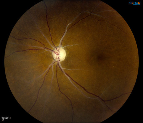 Retinal Artery Occlusion
Patient comes in for eval on artery occlusions in both eyes. VA is 20/400, right eye and NLP, left eye. Fundus photos show paniretinal scars in the right eye with arterial narrowing and the left eye has arterial narrowing as well.
