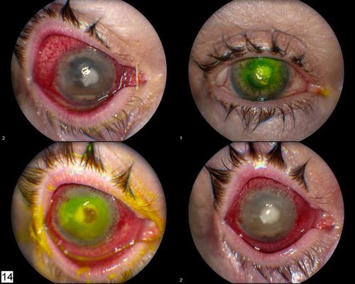 4-up of Cornea Ulcer with Iris Prolaps
